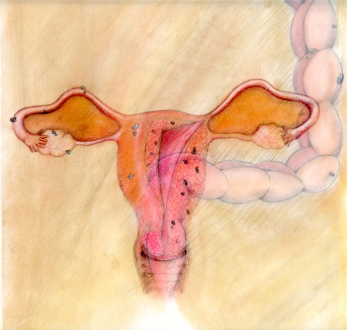 bulky uterus causes