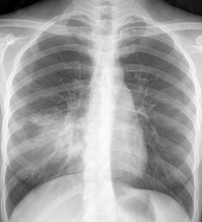 pneumonia cxr middle right lobe ray chest courtesy